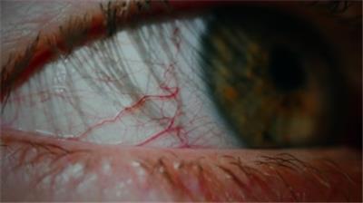  红眼病，红色眼睛，眼睛血丝